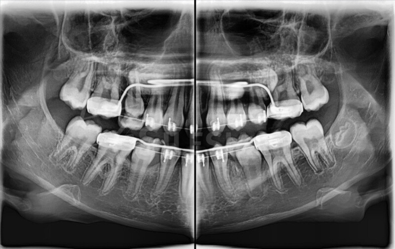 RTG i tomografia CBCT od 100 zł – Świętochłowice
